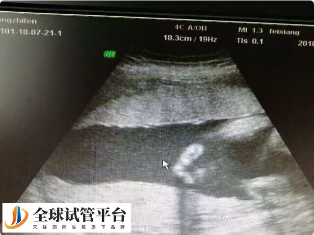 y精子也可以通过生殖系彩超检查健康状态