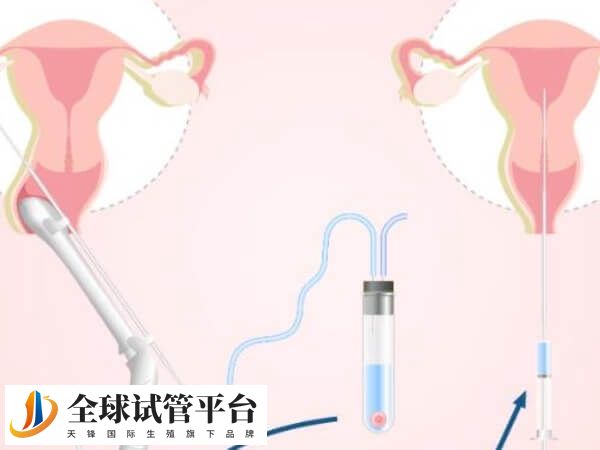 美国四代试管技术