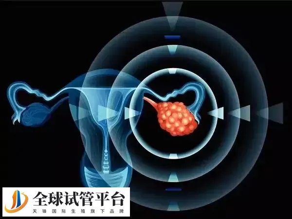 子宫内膜异位会影响卵巢功能