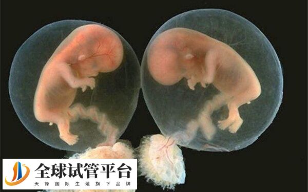 促排卵双胞胎是不是一定要减胎