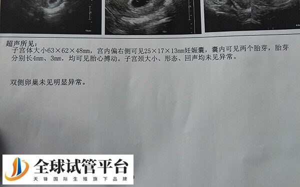 子宫环境不好不建议双胎妊娠