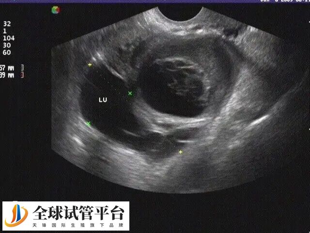 输卵管不通对怀孕有影响