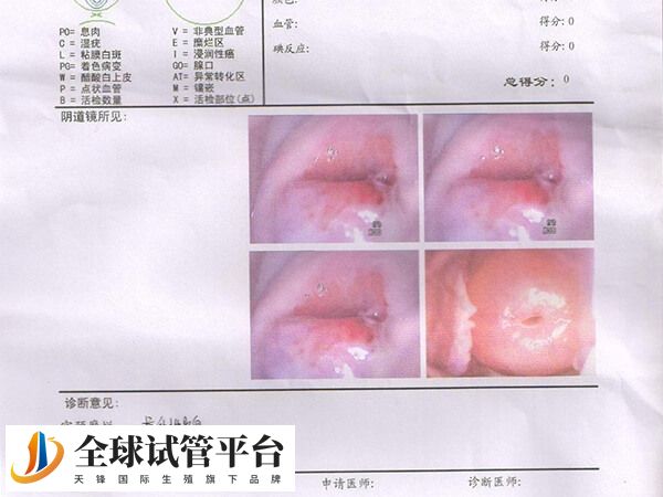 轻度宫颈糜烂一般不需要治疗