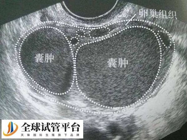 卵巢巧克力囊肿会影响备孕