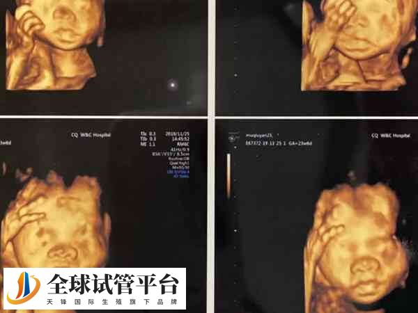 东莞玛丽亚妇产医院做照彩超还送光碟